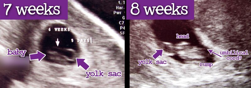 8-week-ultrasound